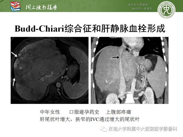 【PPT】肝脏血管性病变影像学表现【RG精选】
