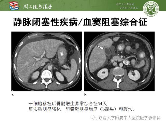 【PPT】肝脏血管性病变影像学表现【RG精选】