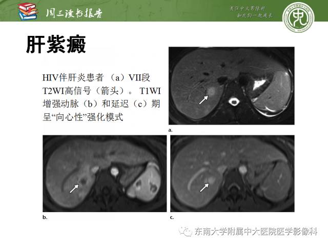 【PPT】肝脏血管性病变影像学表现【RG精选】