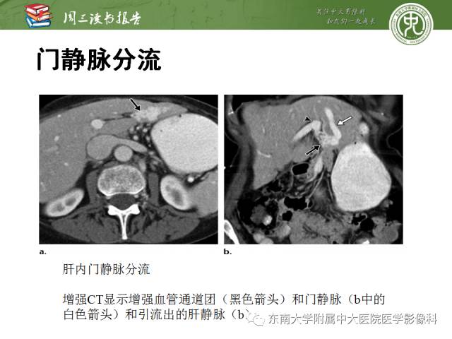 【PPT】肝脏血管性病变影像学表现【RG精选】