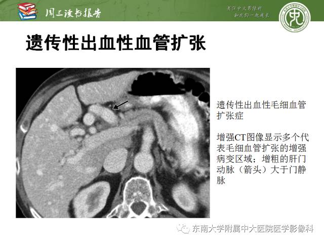 【PPT】肝脏血管性病变影像学表现【RG精选】