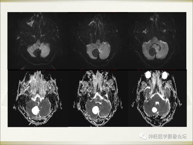 【病例】相似的小脑囊性病变，不一样的病理结果——囊肿VS血管母细胞瘤