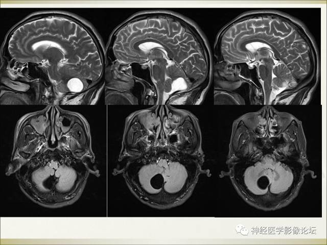 【病例】相似的小脑囊性病变，不一样的病理结果——囊肿VS血管母细胞瘤