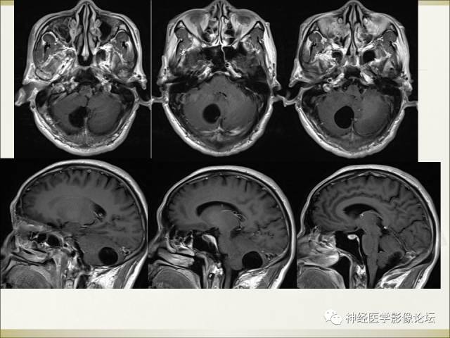 【病例】相似的小脑囊性病变，不一样的病理结果——囊肿VS血管母细胞瘤