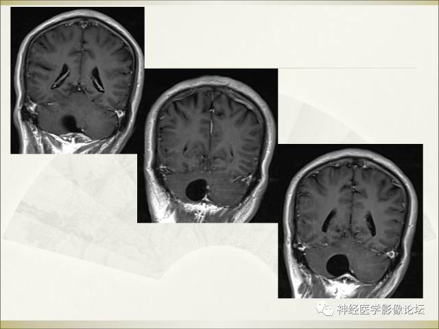 【病例】相似的小脑囊性病变，不一样的病理结果——囊肿VS血管母细胞瘤