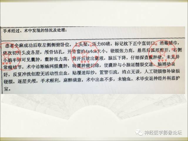 【病例】相似的小脑囊性病变，不一样的病理结果——囊肿VS血管母细胞瘤