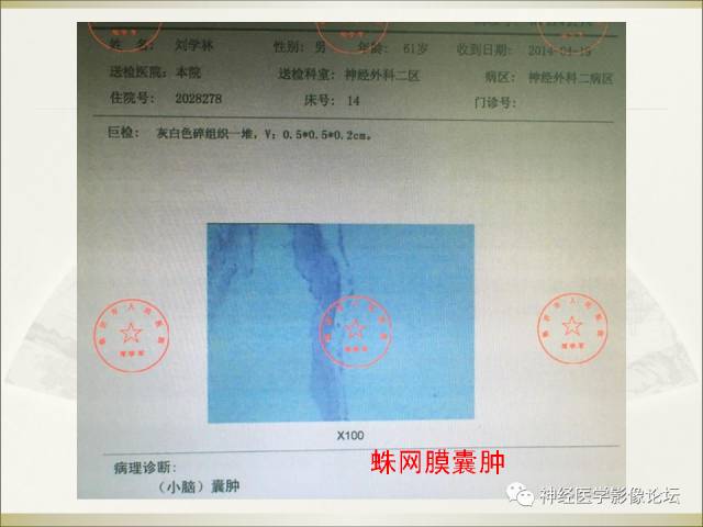 【病例】相似的小脑囊性病变，不一样的病理结果——囊肿VS血管母细胞瘤