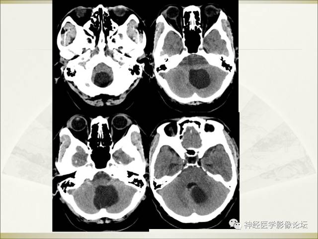 【病例】相似的小脑囊性病变，不一样的病理结果——囊肿VS血管母细胞瘤
