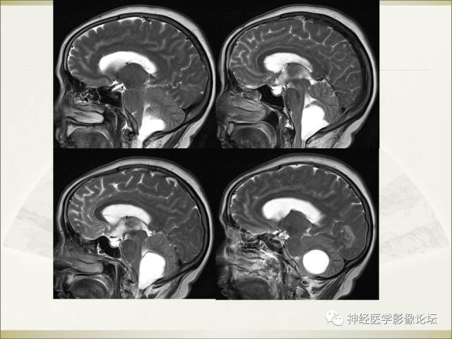 【病例】相似的小脑囊性病变，不一样的病理结果——囊肿VS血管母细胞瘤