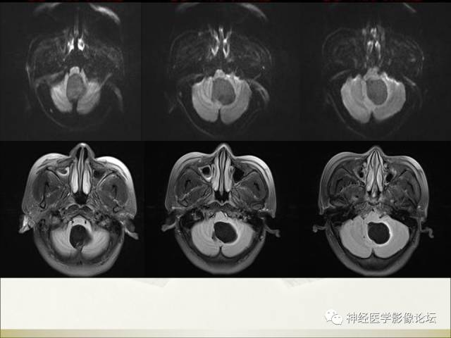 【病例】相似的小脑囊性病变，不一样的病理结果——囊肿VS血管母细胞瘤