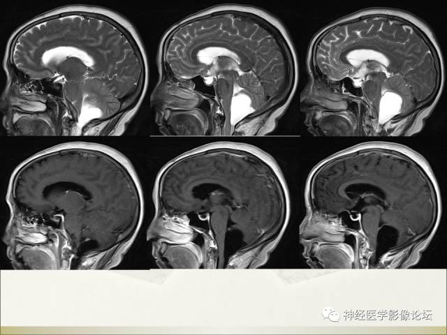 【病例】相似的小脑囊性病变，不一样的病理结果——囊肿VS血管母细胞瘤