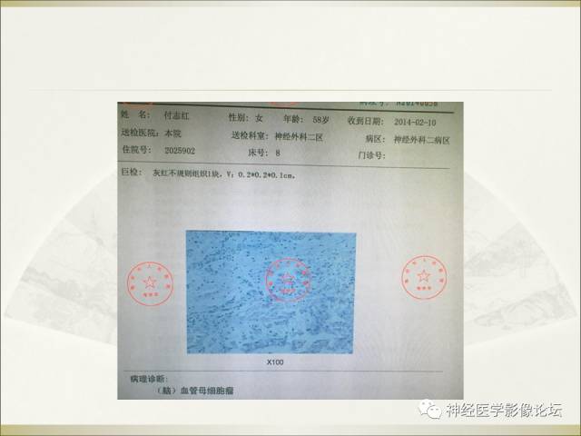 【病例】相似的小脑囊性病变，不一样的病理结果——囊肿VS血管母细胞瘤