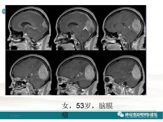 【病例】血管外皮细胞瘤/血管周细胞瘤HPC一例MR