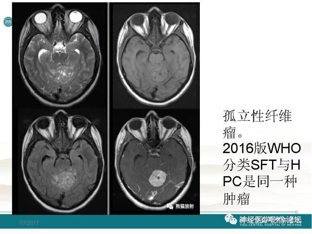 【病例】血管外皮细胞瘤/血管周细胞瘤HPC一例MR