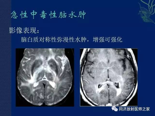 【PPT】酒精相关性脑部改变的影像学表现