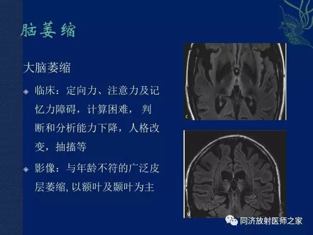 【PPT】酒精相关性脑部改变的影像学表现