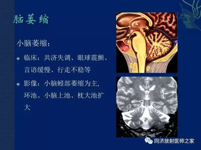 【PPT】酒精相关性脑部改变的影像学表现