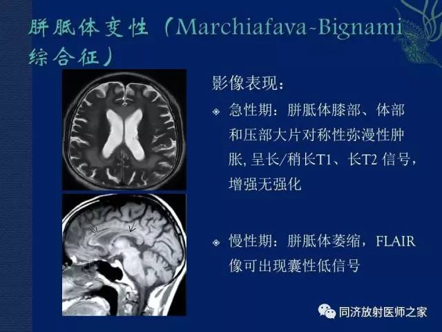 【PPT】酒精相关性脑部改变的影像学表现