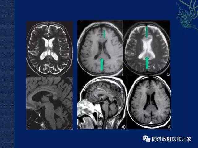 【PPT】酒精相关性脑部改变的影像学表现