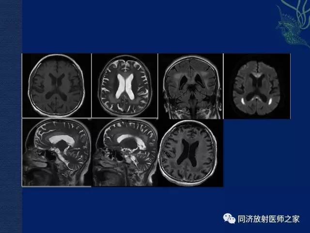 【PPT】酒精相关性脑部改变的影像学表现