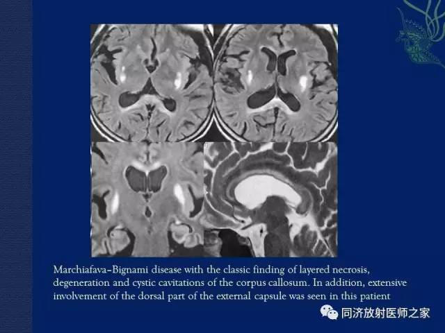 【PPT】酒精相关性脑部改变的影像学表现