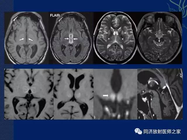 【PPT】酒精相关性脑部改变的影像学表现