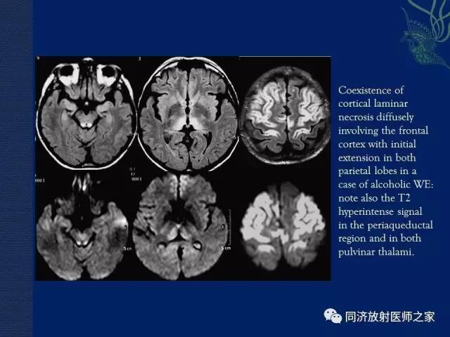 【PPT】酒精相关性脑部改变的影像学表现
