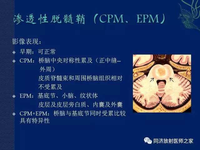 【PPT】酒精相关性脑部改变的影像学表现
