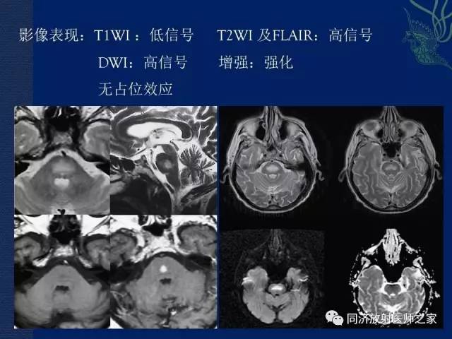 【PPT】酒精相关性脑部改变的影像学表现