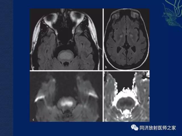【PPT】酒精相关性脑部改变的影像学表现