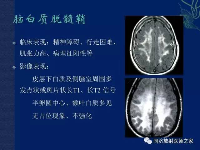 【PPT】酒精相关性脑部改变的影像学表现