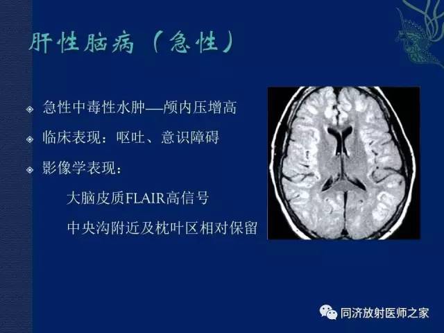 【PPT】酒精相关性脑部改变的影像学表现
