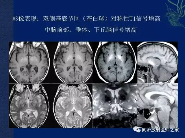 【PPT】酒精相关性脑部改变的影像学表现