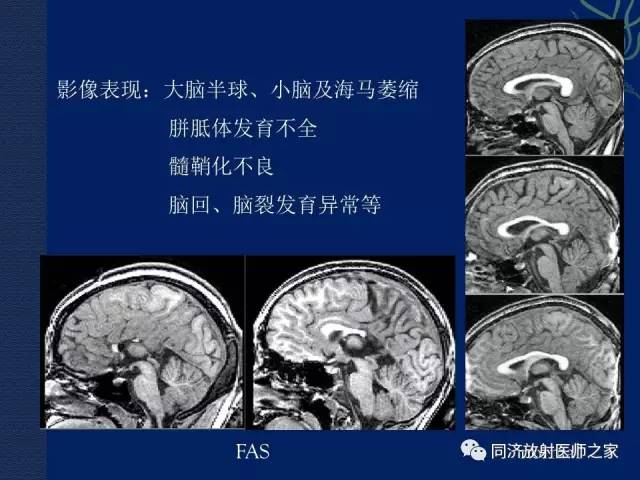 【PPT】酒精相关性脑部改变的影像学表现