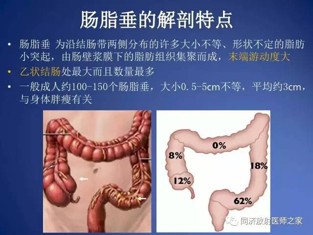 【PPT】急性原发性肠脂垂炎的CT诊断