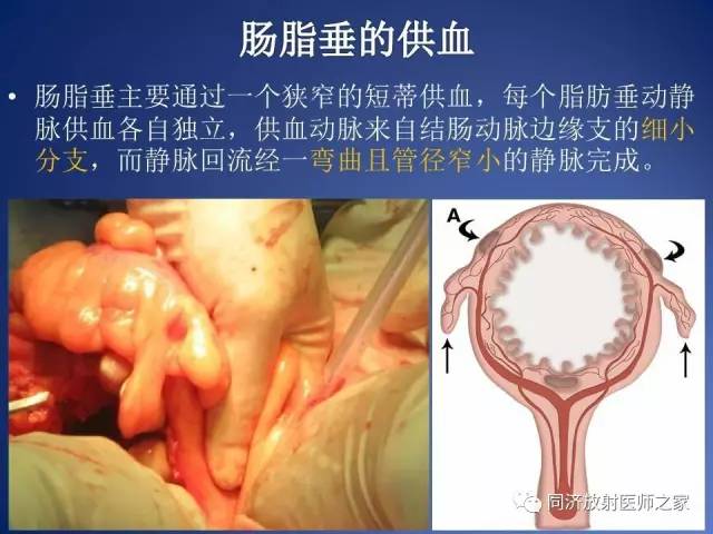 【PPT】急性原发性肠脂垂炎的CT诊断