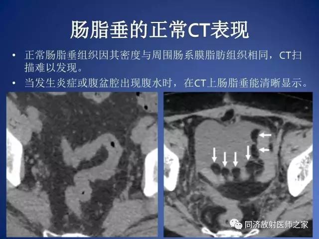 【PPT】急性原发性肠脂垂炎的CT诊断