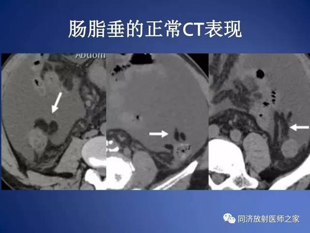 【PPT】急性原发性肠脂垂炎的CT诊断