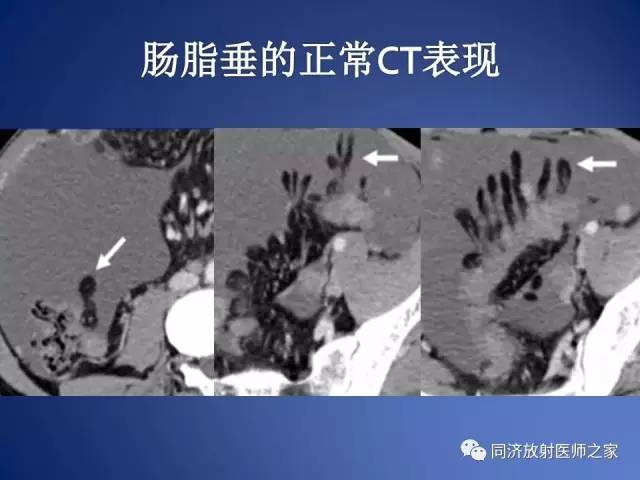 【PPT】急性原发性肠脂垂炎的CT诊断