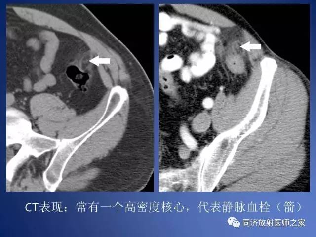 【PPT】急性原发性肠脂垂炎的CT诊断