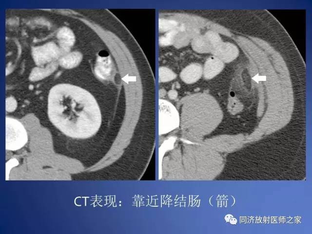 【PPT】急性原发性肠脂垂炎的CT诊断