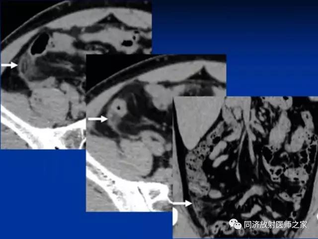 【PPT】急性原发性肠脂垂炎的CT诊断