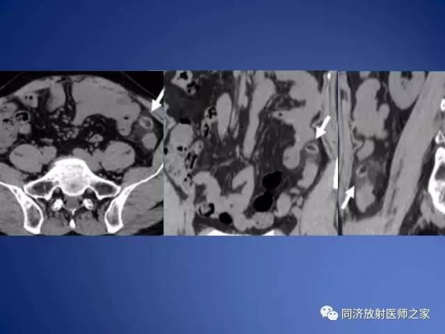 【PPT】急性原发性肠脂垂炎的CT诊断