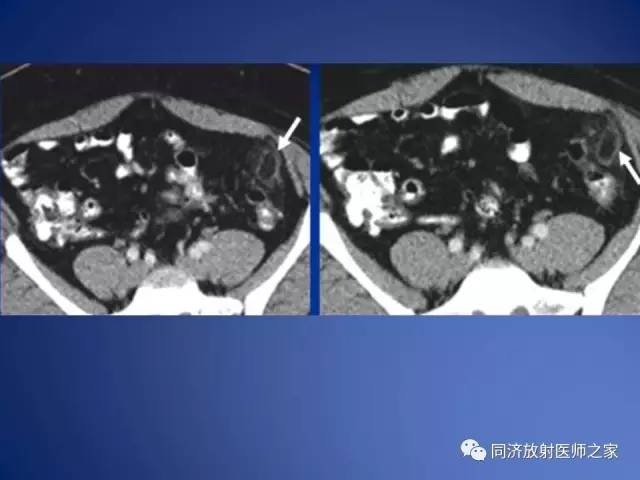 【PPT】急性原发性肠脂垂炎的CT诊断