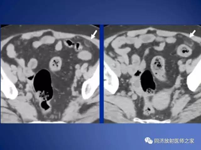 【PPT】急性原发性肠脂垂炎的CT诊断