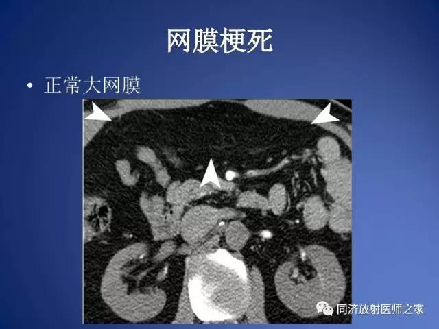 【PPT】急性原发性肠脂垂炎的CT诊断