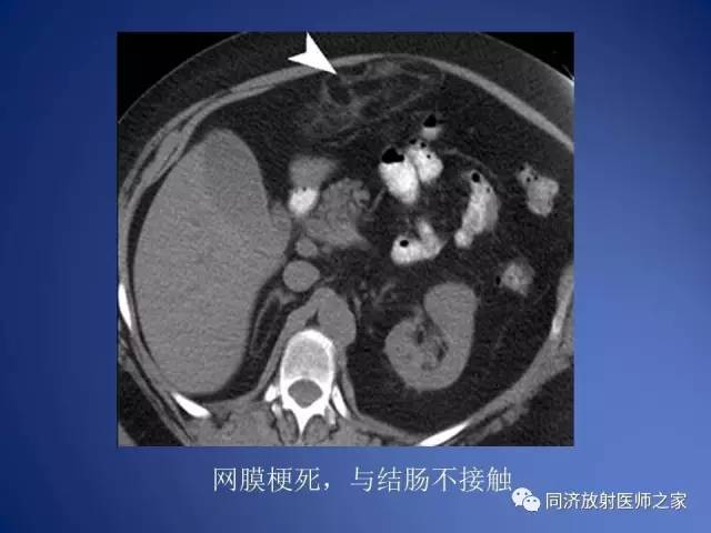 【PPT】急性原发性肠脂垂炎的CT诊断