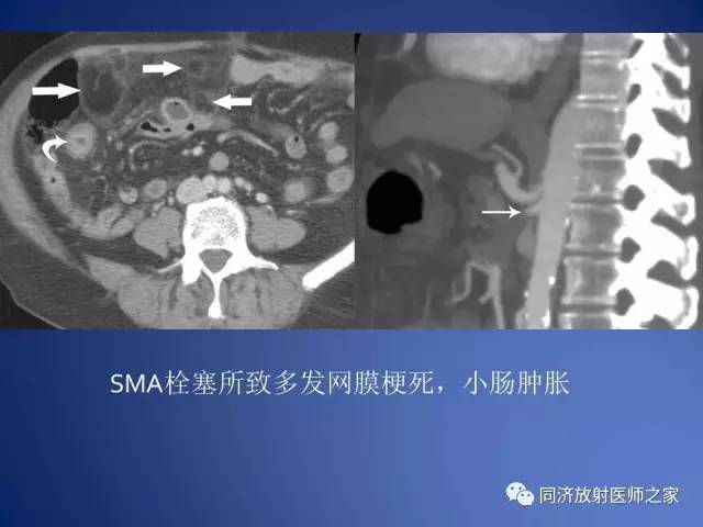 【PPT】急性原发性肠脂垂炎的CT诊断