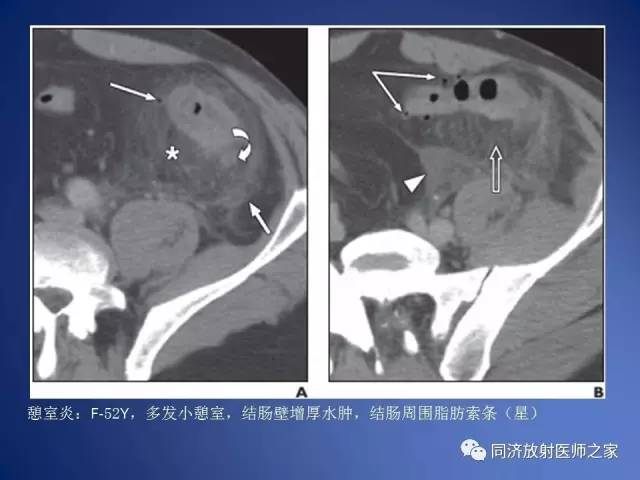 【PPT】急性原发性肠脂垂炎的CT诊断