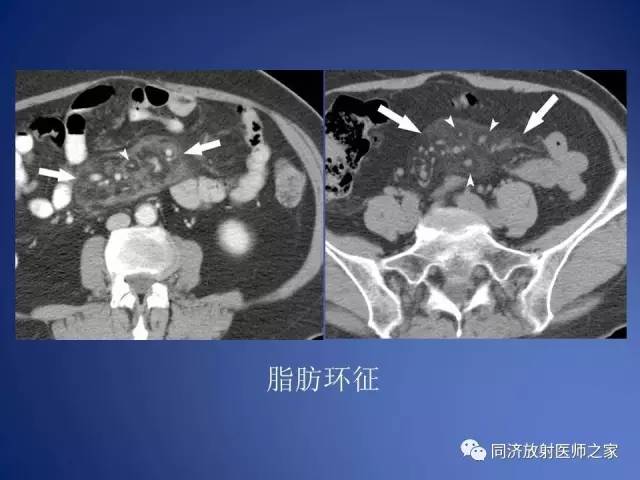 【PPT】急性原发性肠脂垂炎的CT诊断